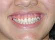 Caso 11 - Sorriso Gengival
