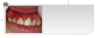 Caso 16 - Aplicação de laser de baixa potência para descontaminação em periodontia.