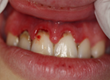 Caso 16 - Aplica&ccedil;&atilde;o de laser de baixa pot&ecirc;ncia para descontamina&ccedil;&atilde;o em periodontia.