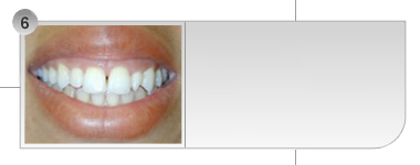 Caso 6 - Cirurgia aumento do sorriso (correção da altura gengival).