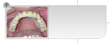 Caso 7 - Dentes condenados por infiltração causada pela prótese.