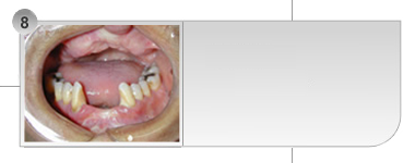 Caso 8 - Over Denture superior (paciente com lábio leporino).