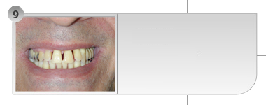 Caso 9 - Reabilitação com Implantes / Facetas Estéticas.