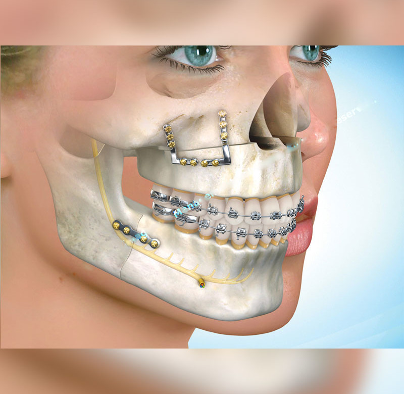 Cirurgia Buco-Maxilo-Facial Ortognática