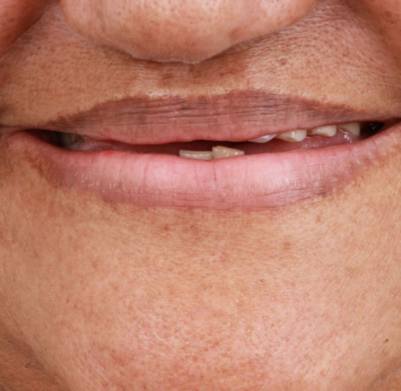 Caso 05 - Implantes Dentários