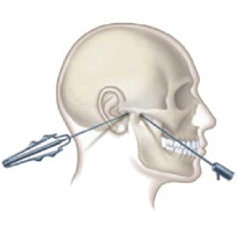 Cirurgia Buco-Maxilo-Facil ATM(DTM)