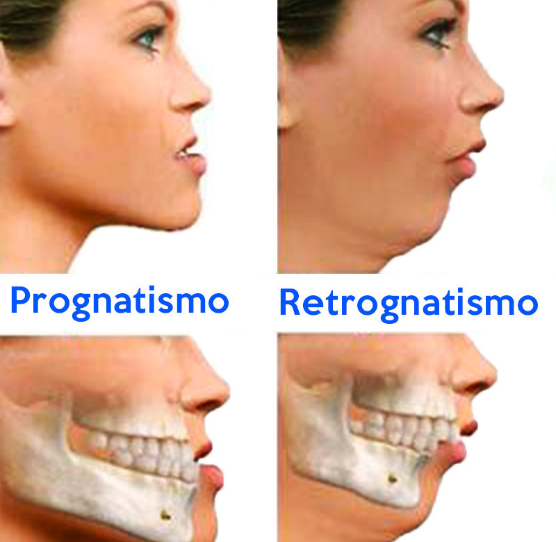 Cirurgia Buco-Maxilo-Facial Ortognática