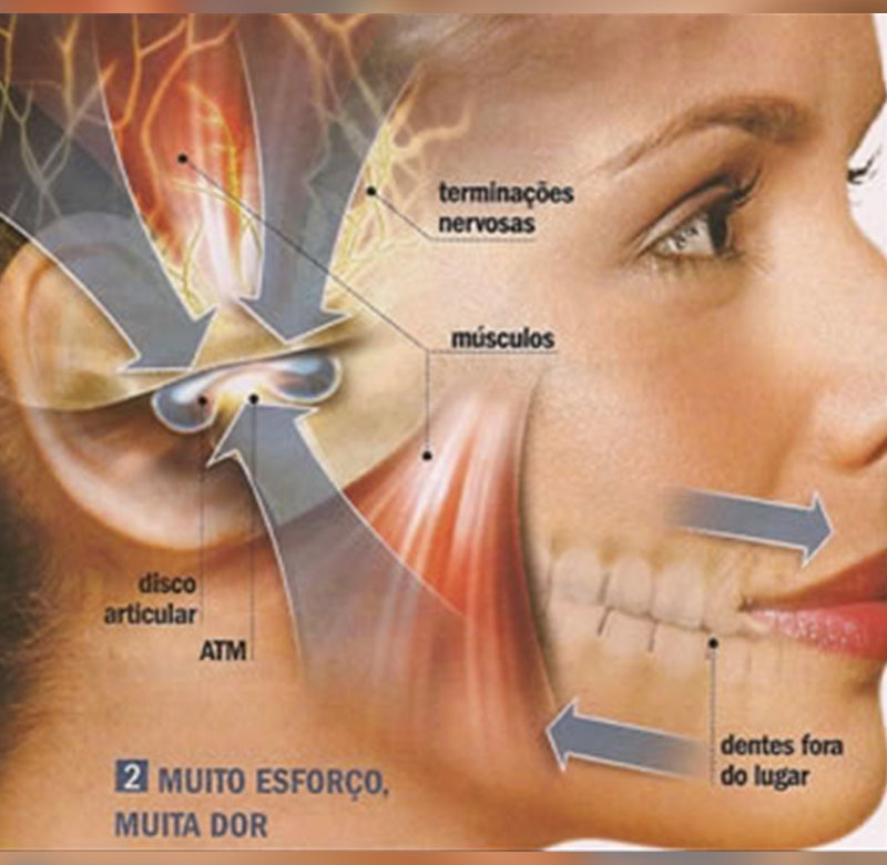 Cirurgia Buco-Maxilo-Facil ATM(DTM)