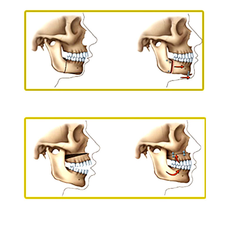 Cirurgia Buco-Maxilo-Facial Ortognática