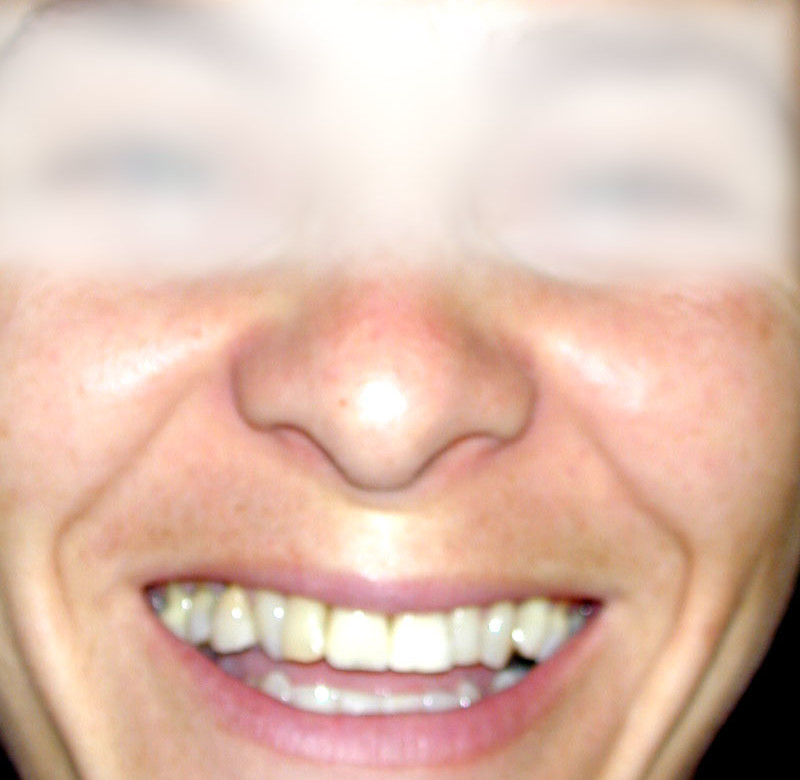 Caso 02 - Implantes Dentários