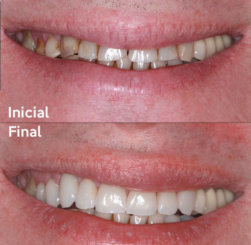 Caso 08 - Dentística (estética)