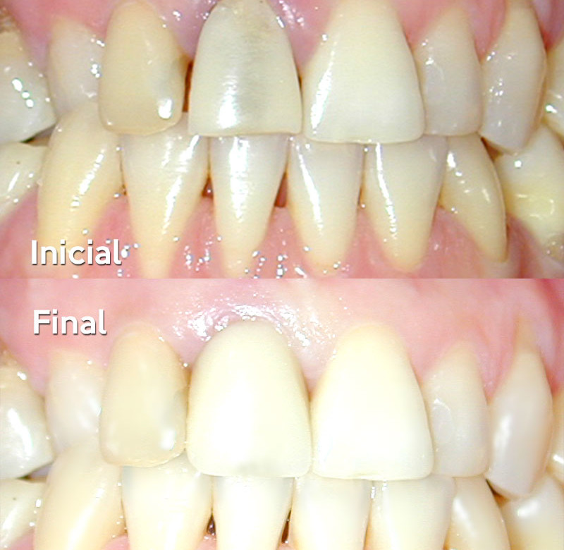 Caso 02 - Implantes Dentários