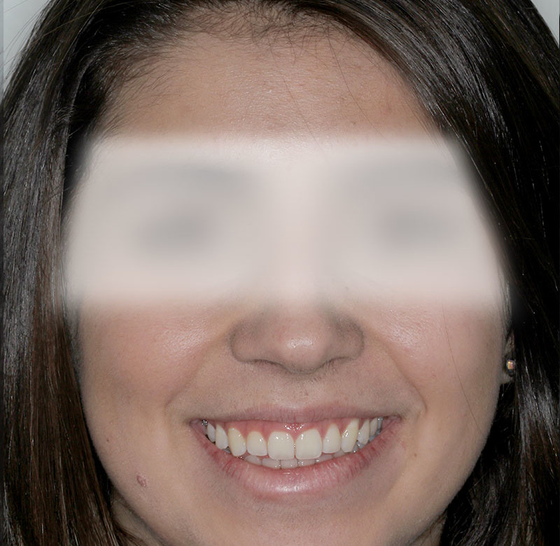 Caso 02 - Dentística (estética)
