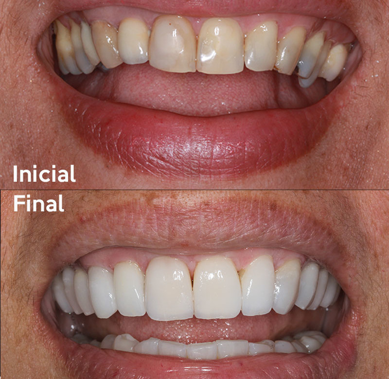 Caso 07 - Dentística (estética)