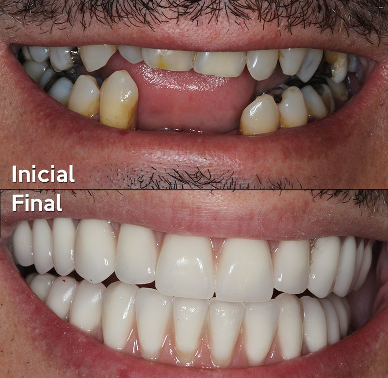 Caso 01 - Implantes Dentários