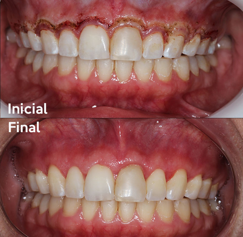 Caso 05 - Dentística (estética)