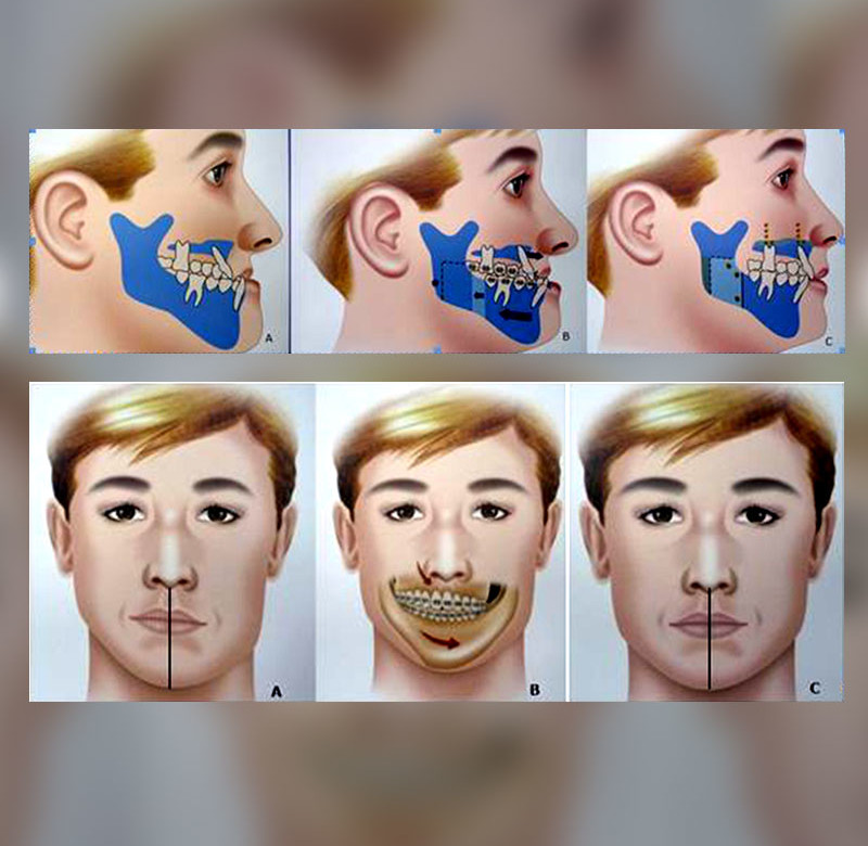 Cirurgia Buco-Maxilo-Facial Ortognática