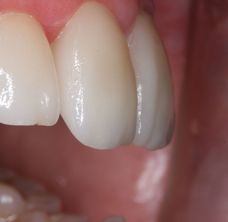 Caso 04 - Dentística (estética)