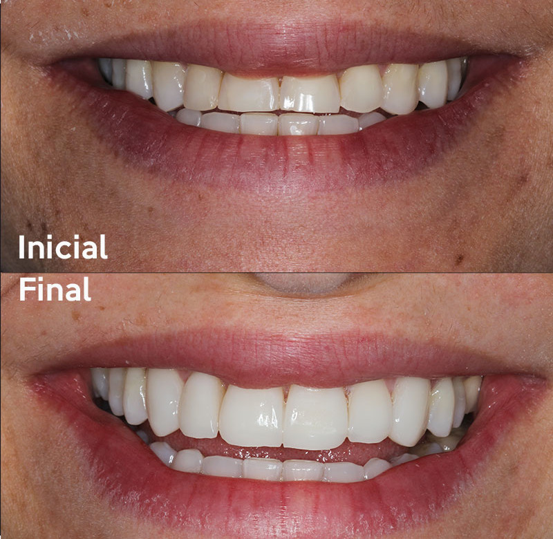 Caso 06 - Dentística (estética)