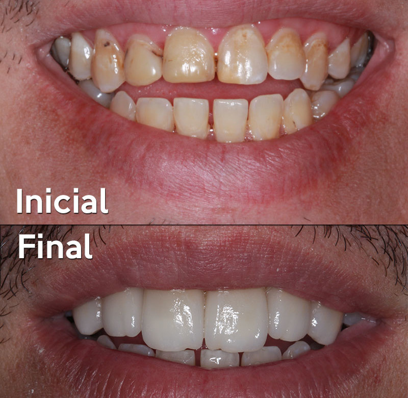 Caso 04 - Dentística (estética)