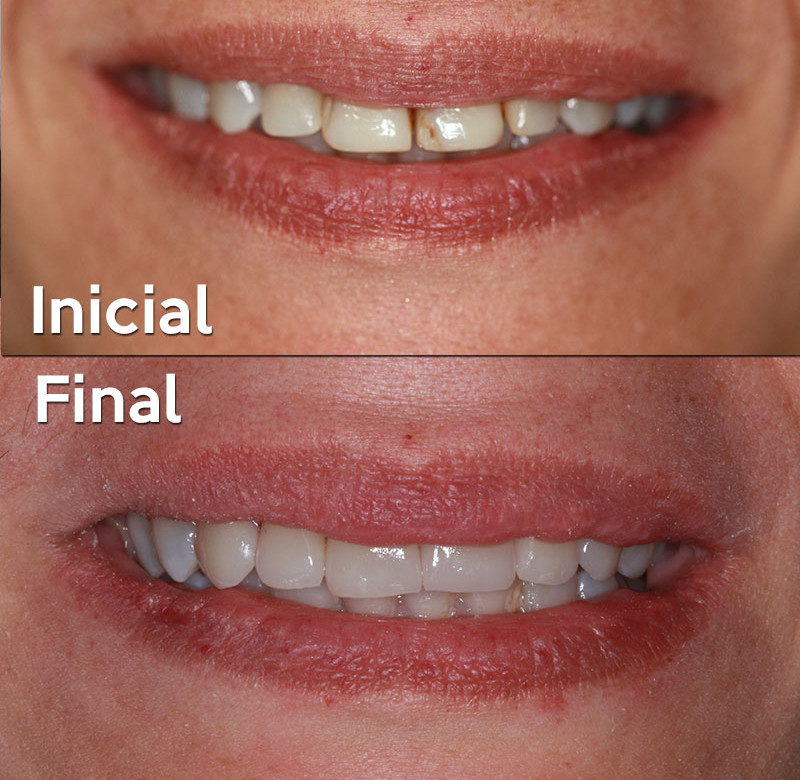 Caso 03 - Dentística (estética)