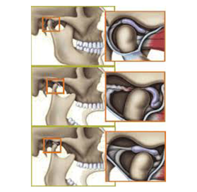 Cirurgia Buco-Maxilo-Facil ATM(DTM)