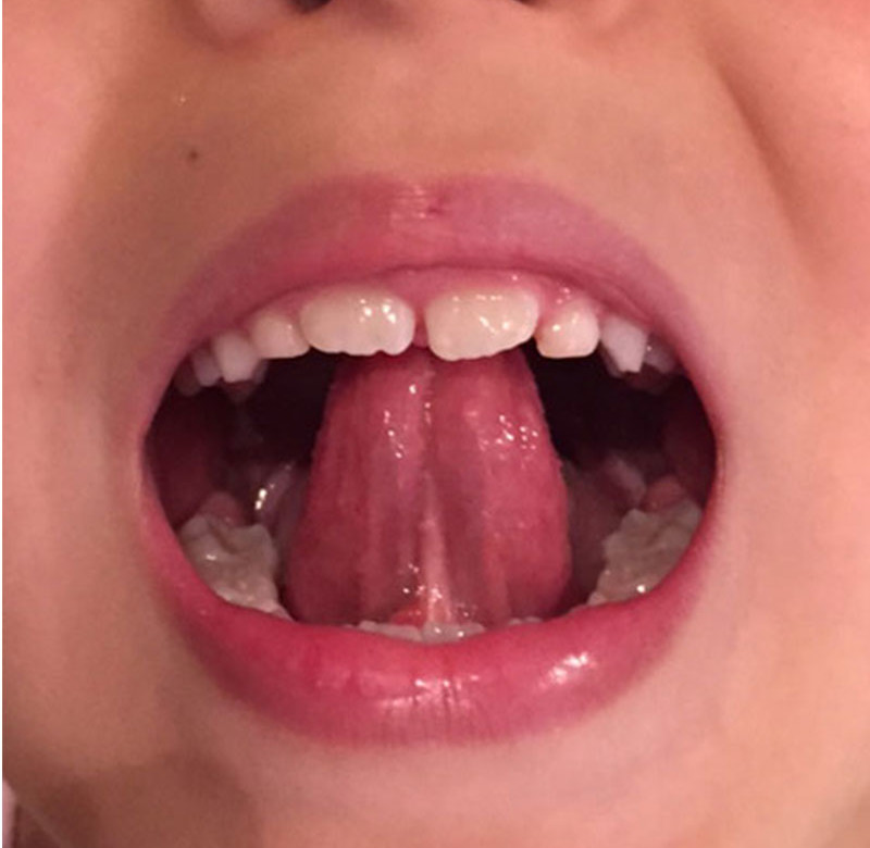 Caso 01 - Frenectomia Lingual - Cirurgia a Laser