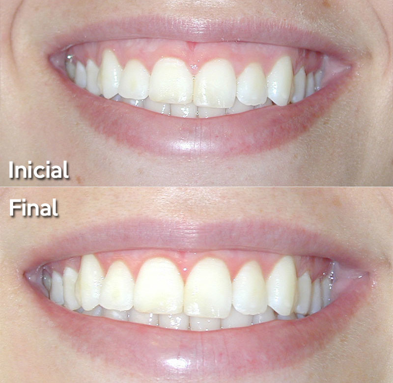 Caso 02 - Sorriso Gengival - Cirurgia a Laser
