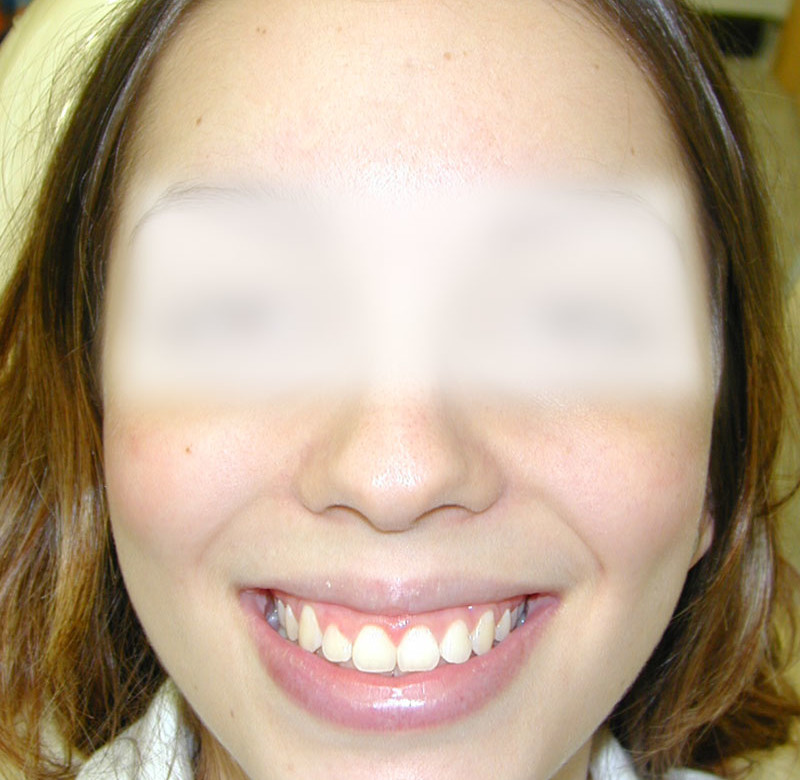 Caso 03 - Sorriso Gengival