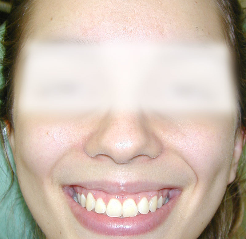 Caso 03 - Sorriso Gengival