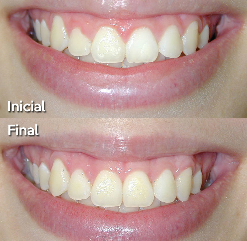 Caso 03 - Sorriso Gengival