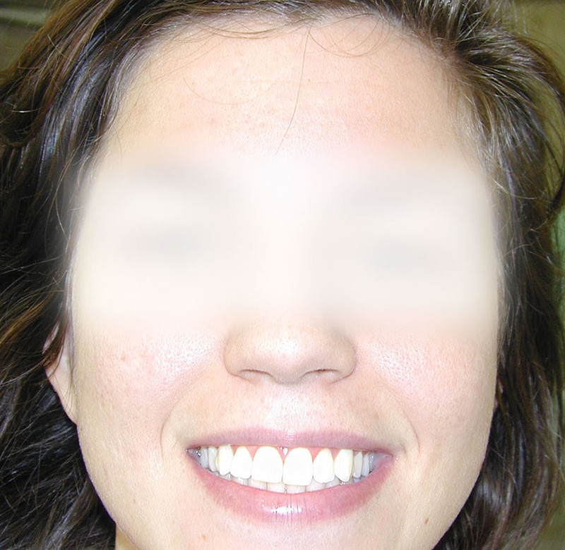 Caso 02 - Sorriso Gengival - Cirurgia a Laser