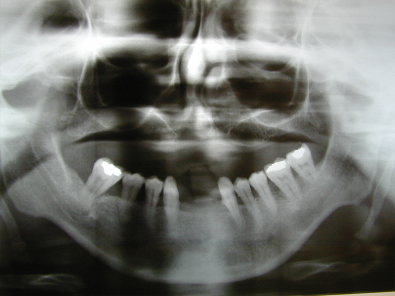 Radiografia-panoramica