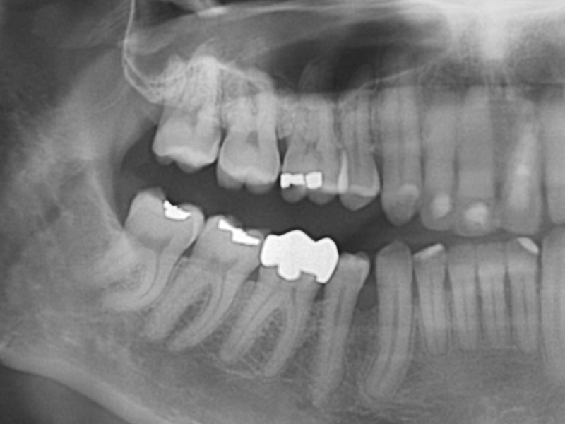 Radiografia-peripical-