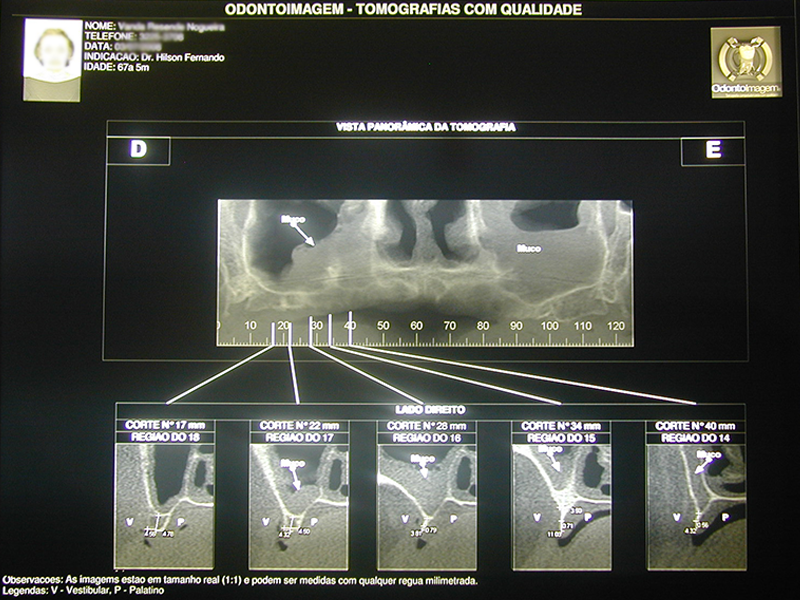 Tumografia-computadorizada